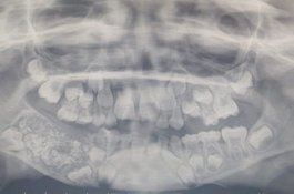 Dokter Heran, Kok Bisa Bocah Ini Punya 500 Lebih Gigi di Mulutnya