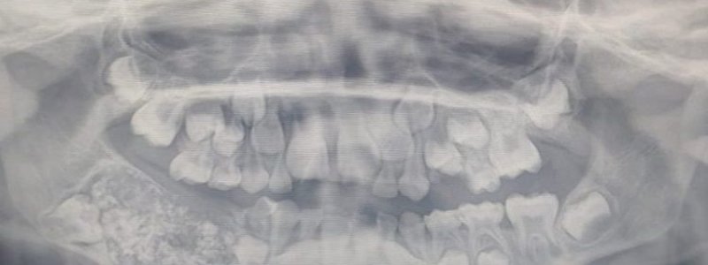 Dokter Heran, Kok Bisa Bocah Ini Punya 500 Lebih Gigi di Mulutnya