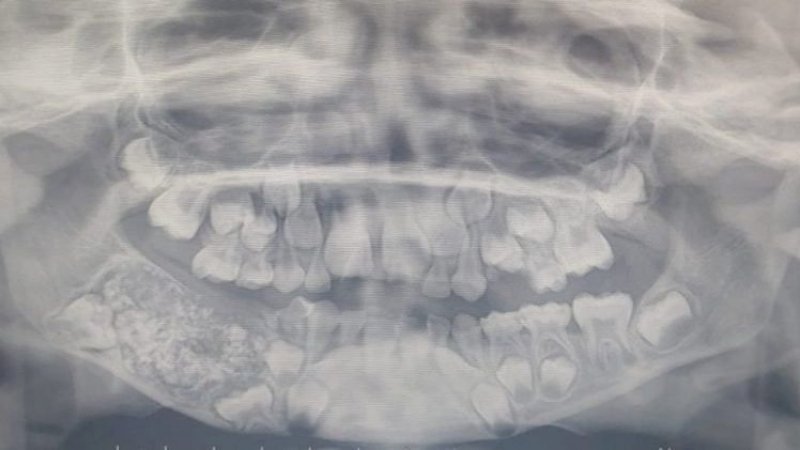 Gusi Ravindra yang dilihat melalui pemeriksaan X-ray | www.odditycentral.com 