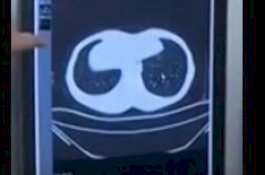 Paru-paru Pria Ini Penuh Cacing karena Gemar Konsumsi Makanan Mentah