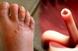 Tak Memakai Sendal saat Bermain, Kaki Bocah Ini Kemasukan Larva Cacing dan Berubah Jadi Mengerikan