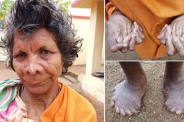 Bukannya Diberi Bantuan, Wanita yang Punya 31 Jari Ini Sering Disebut Penyihir oleh Tetangganya