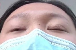 Akibat Operasi Plastik yang Gagal, Wanita Ini Terpaksa Tidur dengan Mata Terbuka