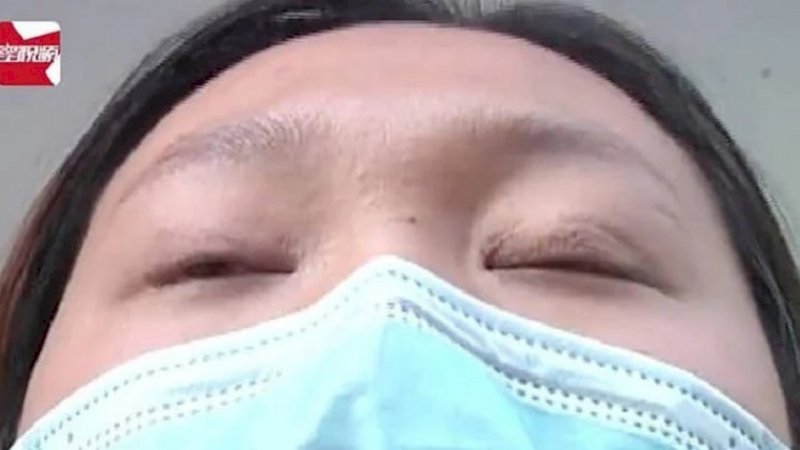 Akibat Operasi Plastik yang Gagal, Wanita Ini Terpaksa Tidur dengan Mata Terbuka