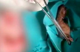 Ikan Nila Utuh Ditemukan Dalam Usus Pria Ini, Diduga Masuk Lewat Anus