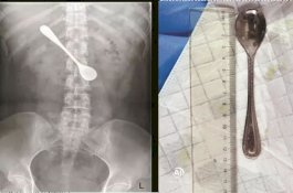 Wanita Ini Coba Hilangkan Tulang Ikan di Tenggorokan, Malah Sendok 13 Cm yang Tertelan
