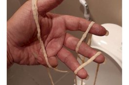 Mengeluh Susah BAB, Ternyata Ada Cacing Pita 9 Meter Sumbat Anus Pria Ini