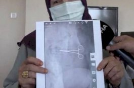 Gunting Bedah Tertinggal di Dalam Perut Wanita Ini, Baru Ketahuan 2 Bulan Usai Operasi