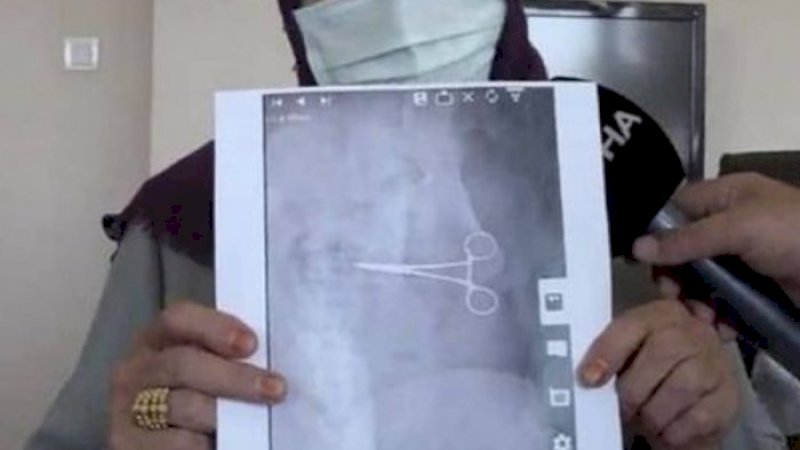 Gunting Bedah Tertinggal di Dalam Perut Wanita Ini, Baru Ketahuan 2 Bulan Usai Operasi