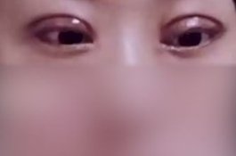 Habiskan Rp44 Juta untuk Operasi Kelopak Mata Ganda yang Gagal, Wanita Ini Diceraikan Suami