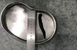 Leher Gatal Hingga Batuk Berdarah, Ternyata Ada Lintah 10 Cm Bersarang di Tenggorokan Pria Ini