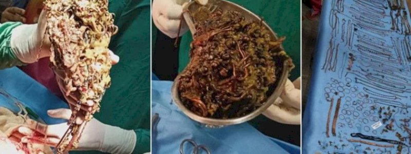 Perut Wanita Ini Dibelah, Dokter Kaget Temukan 69 Rantai, 80 Anting, dan 11 Cincin