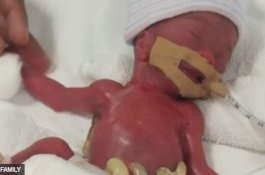 Bayi Terkecil di Dunia Lahir dengan Berat 212 Gram, Begini Kondisinya Sekarang