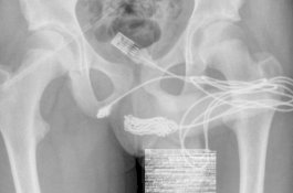 Iseng Ukur Kejantanan, Kabel USB yang Kusut Bersarang dalam Uretra Remaja 15 Tahun