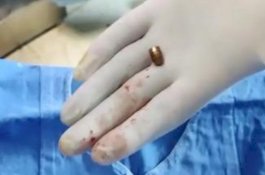 Awalnya Dikira Cakaran Kucing, Pria Ini Baru Sadar Tertembak saat Teman Temukan Selongsong Peluru