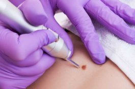 Menangis saat Operasi Pengangkatan Tahi Lalat, Wanita Ini Dikenakan Biaya Tambahan oleh RS