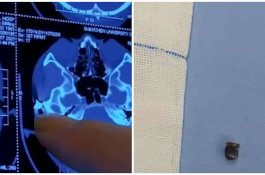 Sering Mengeluh Sakit Kepala, Ternyata Ada Peluru Bersarang Puluhan Tahun di Tengkorak Pria Ini