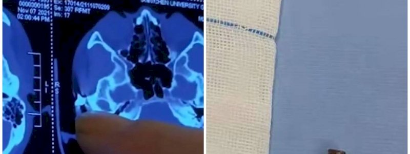 Sering Mengeluh Sakit Kepala, Ternyata Ada Peluru Bersarang Puluhan Tahun di Tengkorak Pria Ini