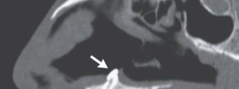 Pria Ini Kesulitan Bernapas Bertahun-tahun, Ternyata Ada Gigi Tumbuh di Rongga Hidung