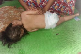 Diduga Kurang Gizi, Balita di Gowa Alami Pembesaran Kepala dan Infeksi