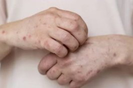 WHO Tetapkan Cacar Monyet Jadi Darurat Kesehatan Dunia