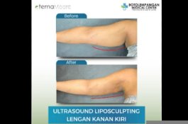 Ingin Langsing Instan? Klinik Eterna Moore Kenalkan LiPo Suction Ultrasound Berteknologi Tinggi