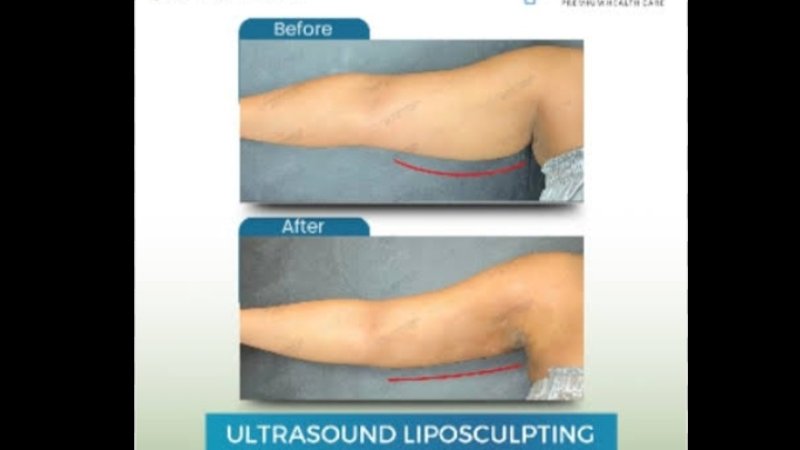 Liposuction Ultrasound di Eterna Moore