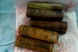 Pria Datang ke RS Mengeluh Sakit Perut, Dokter Keluarkan Uang Rp6 Juta, Koin, 39 Paku, dan Gunting