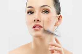 Tips Sederhana Mengatasi Jerawat untuk Kulit Berminyak