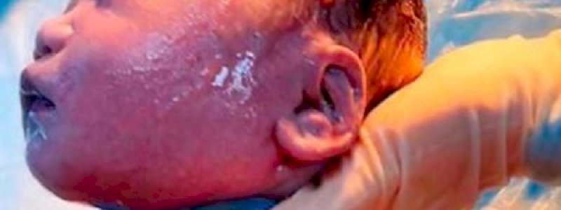 Seperti Ular, Enam Lilitan Tali Pusar di Leher Bayi Ini dan Dia Selamat