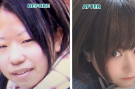 Habiskan Uang Rp597 Juta untuk Operasi Plastik, Lihat Transformasi Wajah Wanita Ini