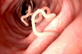 Akibat Makan Daging Mentah, Cacing Pita 5 Meter Bersarang di Tubuh Pria Ini