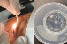 Puluhan Cacing Hidup Dikeluarkan dari Mata Kakek 60 Tahun