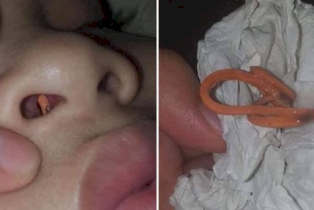 Muncul Bau Busuk Dari Dalam Hidung Saat Dicek Ada Karet Gelang Terperangkap
