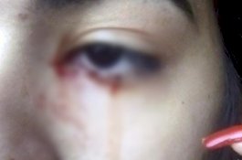 Penyebabnya Masih Misteri, Gadis Remaja Keluarkan Darah dari Mata
