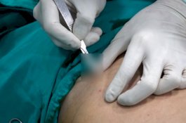 Detik-Detik Menegangkan Dokter Keluarkan Pisau Dapur dari Perut Pria, Ternyata Pengganti Ganja