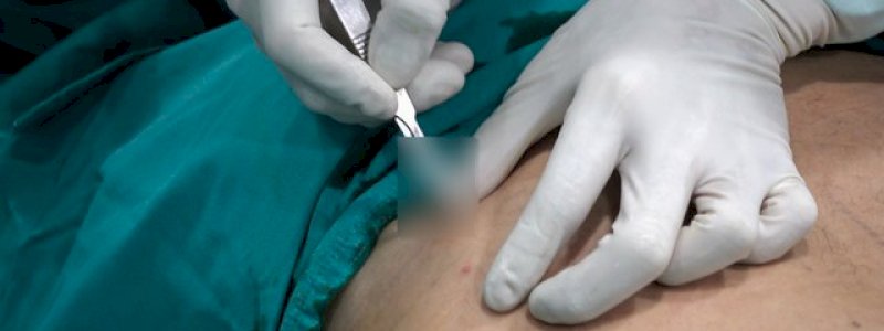 Detik-Detik Menegangkan Dokter Keluarkan Pisau Dapur dari Perut Pria, Ternyata Pengganti Ganja