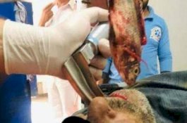 Kondisinya Terancam, Beruntung Ikan Hidup Berhasil Dikeluarkan dari Tenggorokan Nelayan