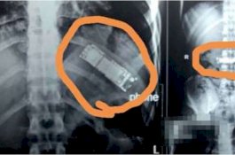Awalnya Bercanda Telan Ponsel, 7 Bulan Kemudian Baru Bisa Dikeluarkan dari Perut