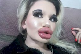 Hampir Menyentuh Hidung, Inilah Wanita Pemilik Bibir Terbesar di Dunia
