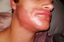 Wajahnya Terbakar Usai Menyemir Jenggot dan Kumis, Pria Ini Harus Minum Obat Sebulan