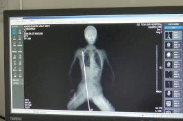 Belum Ajalnya, Wanita Ini Selamat Setelah Jatuh dari Gedung dan Tertembus Besi 1 Meter