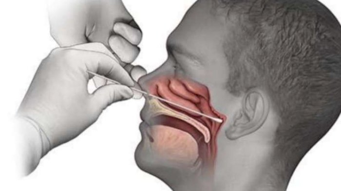 Duh, this man accidentally swallowed the Covid-19 swab tool