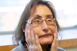 Penerima Transplantasi Wajah Pertama Amerika Serikat Meninggal Dunia