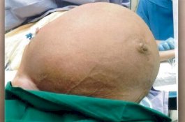 Perempuan India Idap Tumor Ovarium Ekstrem yang Beratnya Sampai 50 Kg