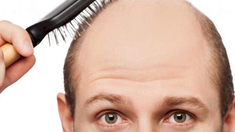 Waspada, Kekurangan 5 Zat Gizi Ini Bikin Rambut Rontok